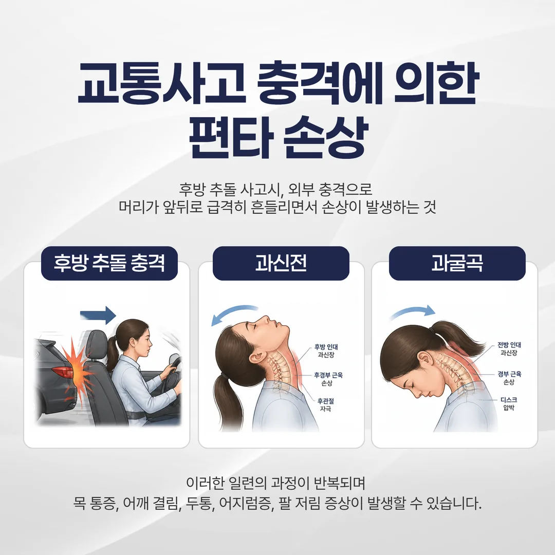 교통사고 편타성 손상 경추 염좌 발생 메커니즘