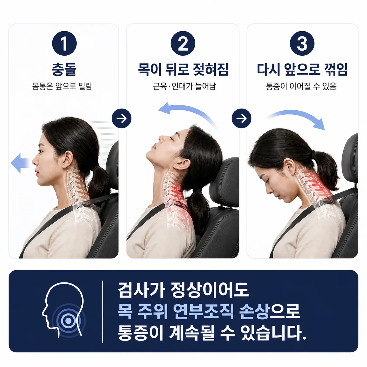 교통사고 편타손상으로 목이 앞뒤로 꺾이는 과정 인포그래픽