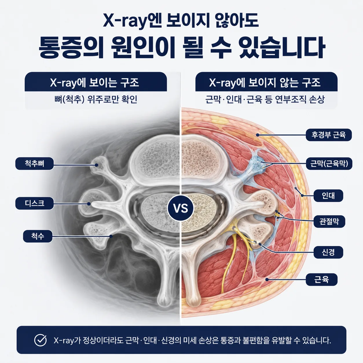 영상검사에 보이지 않는 연부조직 손상 부위 일러스트
