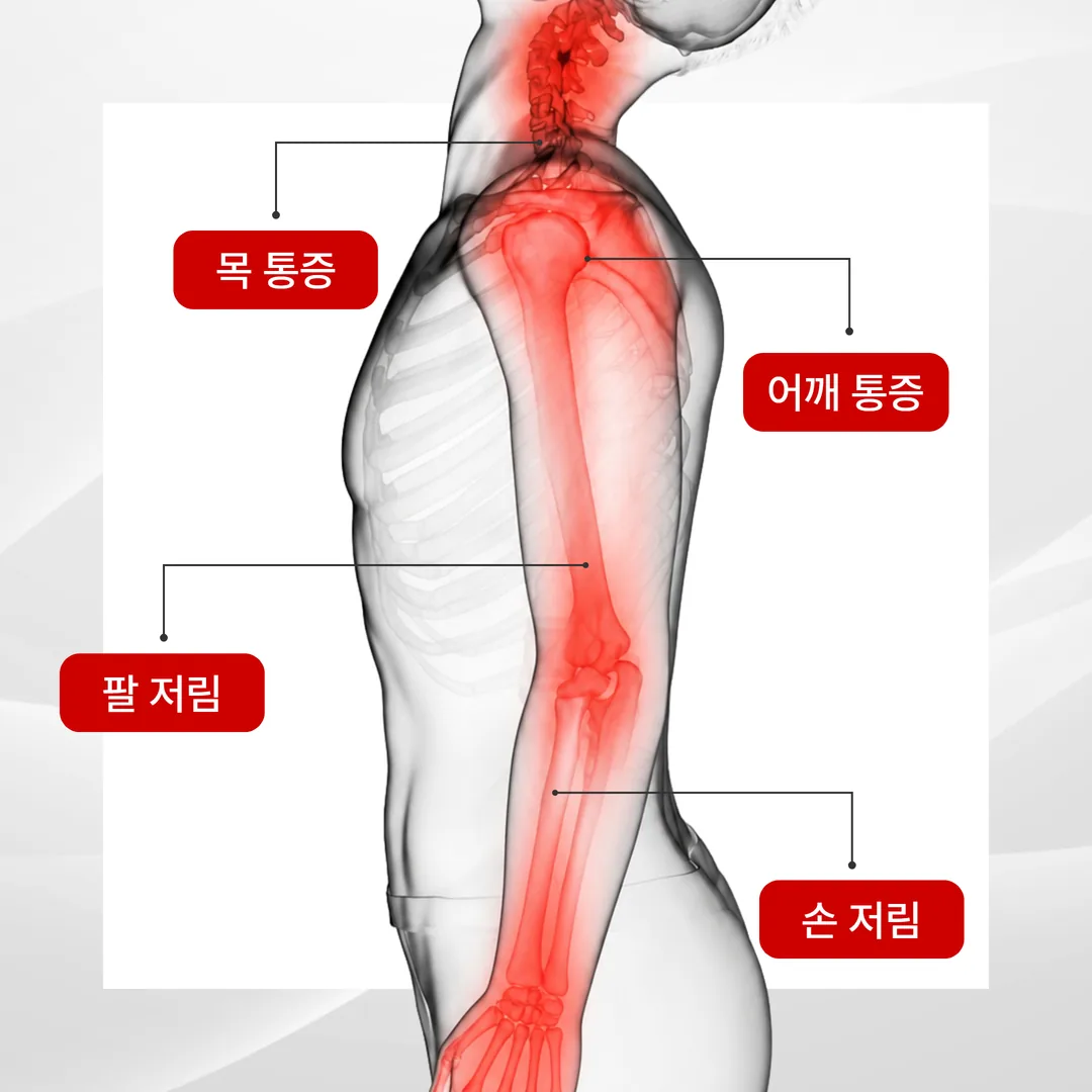 목디스크 초기 증상 목 어깨 통증과 팔 손 저림