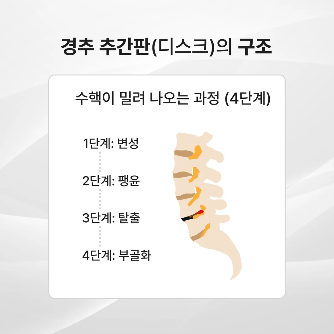경추 추간판탈출증 목디스크 원인 구조도