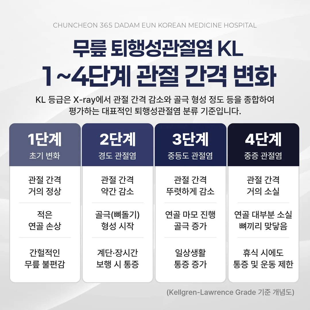 퇴행성관절염 KL grade 단계별 무릎 관절 간격 비교