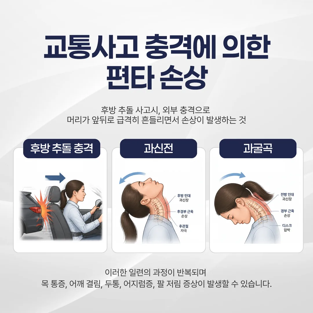 교통사고 충격으로 경추가 과신전·과굴곡되는 편타손상을 설명한 그림