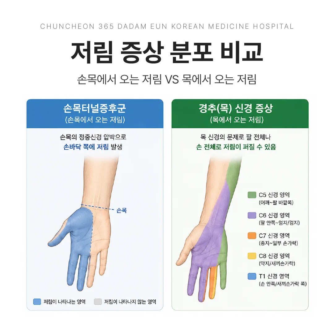 손목터널증후군과 경추 신경 증상의 저림 분포 비교