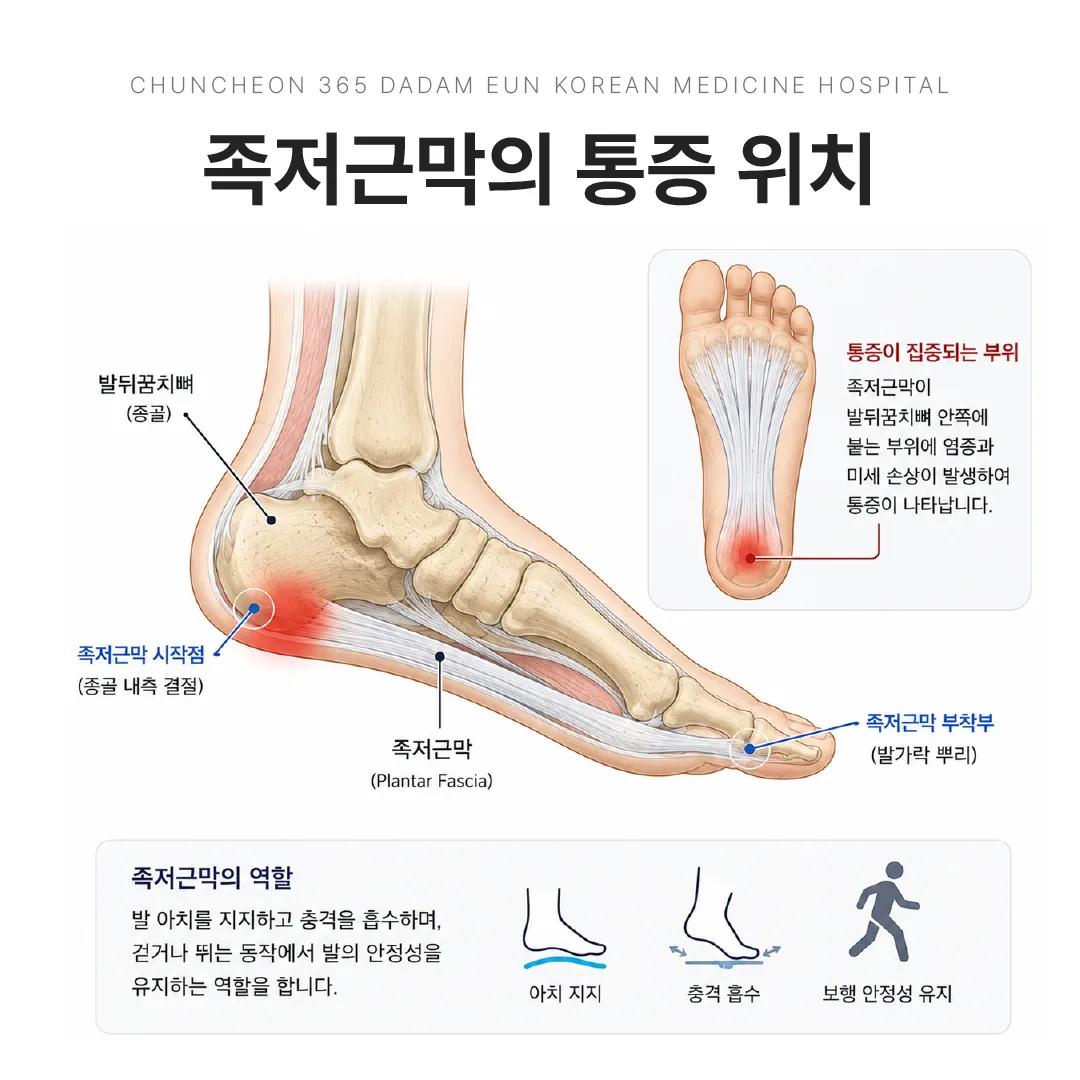 족저근막의 해부학적 위치와 발뒤꿈치 안쪽 통증 부위