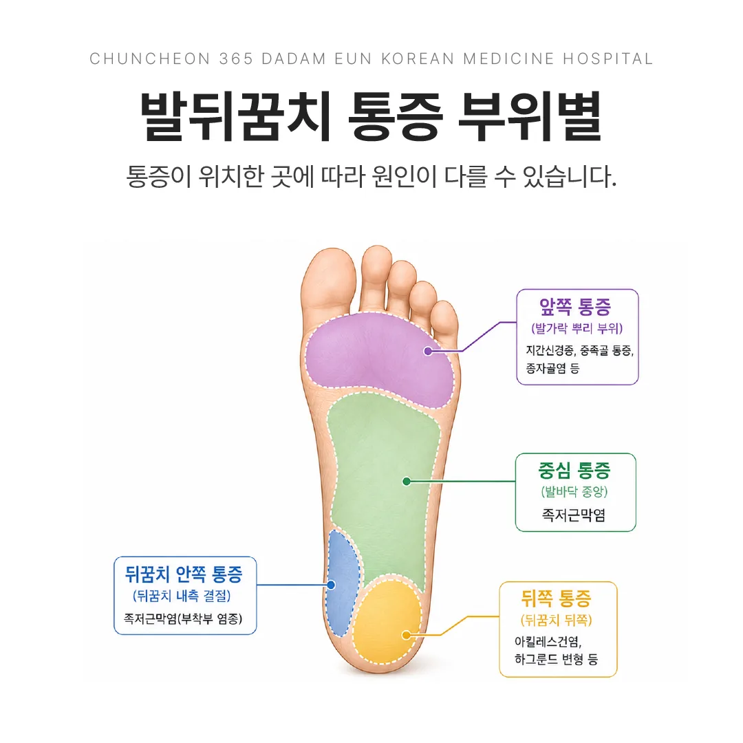 발뒤꿈치 통증 부위별 감별 지도