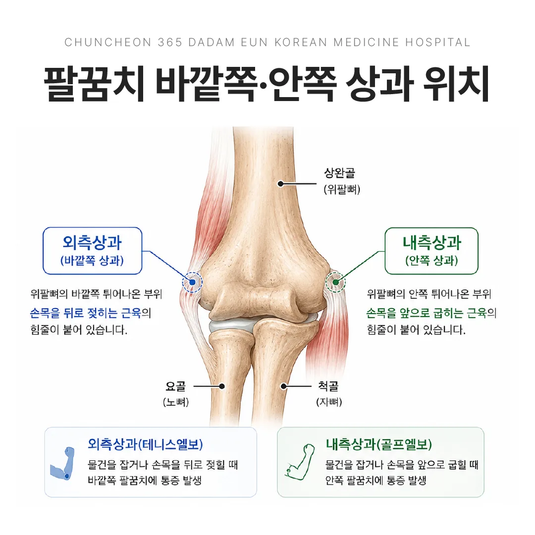 팔꿈치 바깥쪽 외측상과와 안쪽 내측상과 위치를 표시한 그림