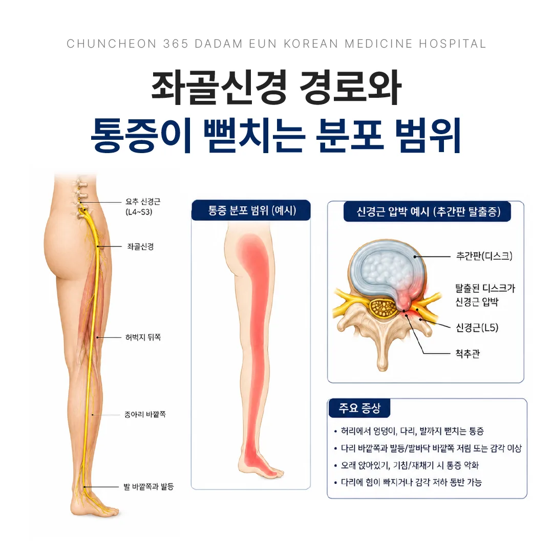좌골신경 경로와 통증이 뻗치는 분포 범위