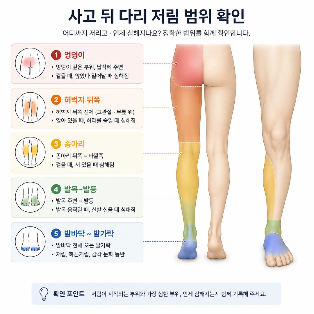 교통사고 다리 저림 범위를 엉덩이에서 발까지 구간으로 표시한 도식