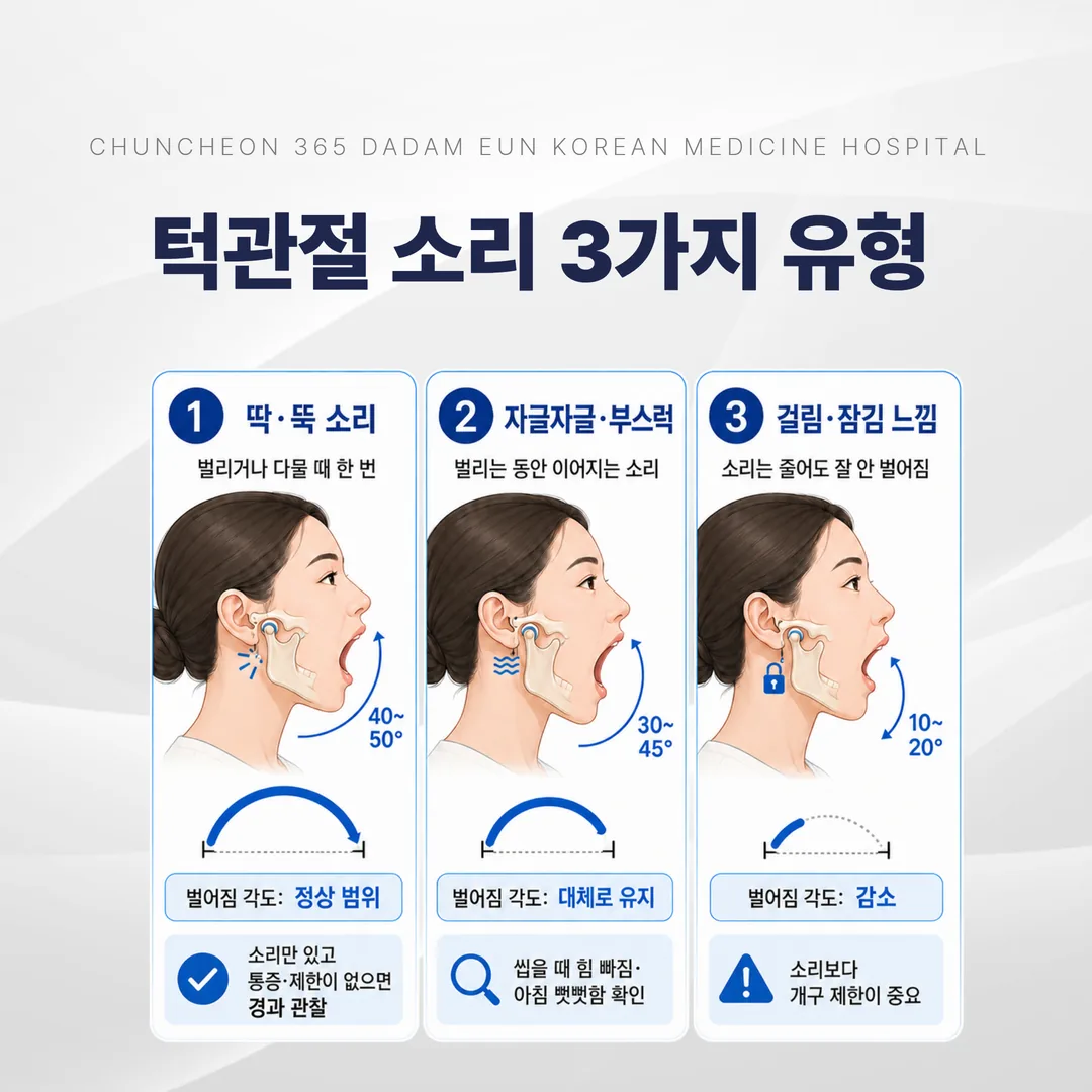턱관절 소리 세 가지 유형을 벌어지는 각도와 함께 나눈 도해