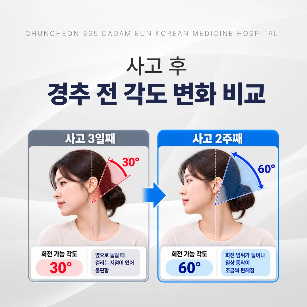 교통사고 후 경추 회전 각도가 2주 사이에 얼마나 늘었는지 비교한 그림