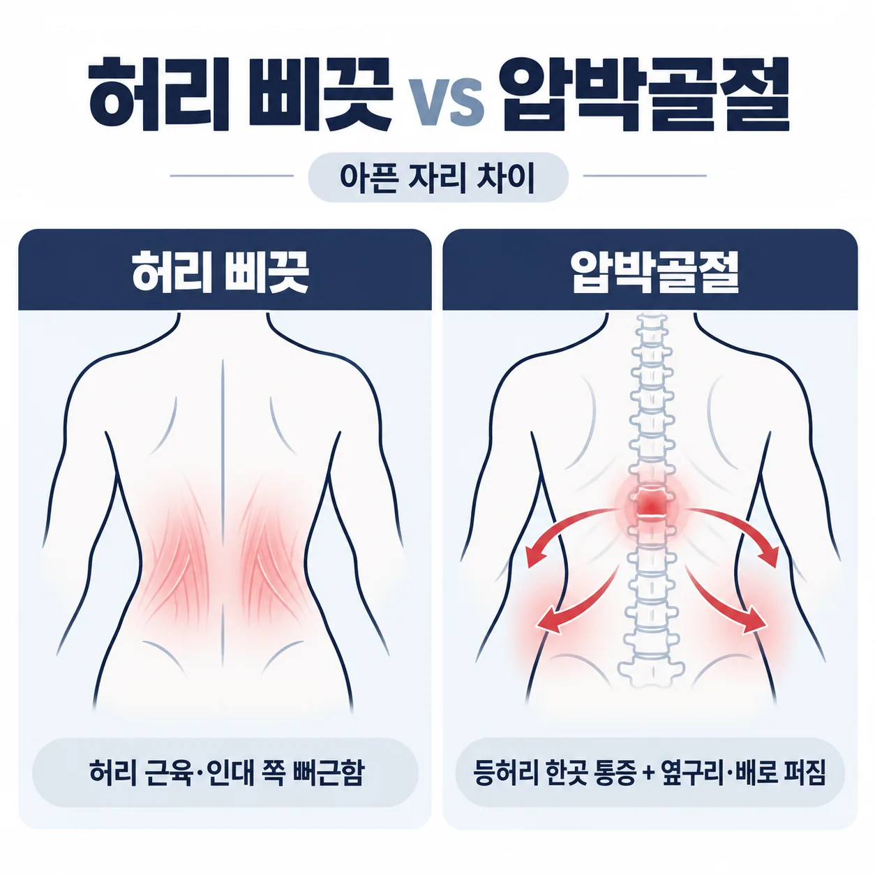 허리 삐끗과 골다공증 압박골절의 아픈 자리 차이를 견준 도식