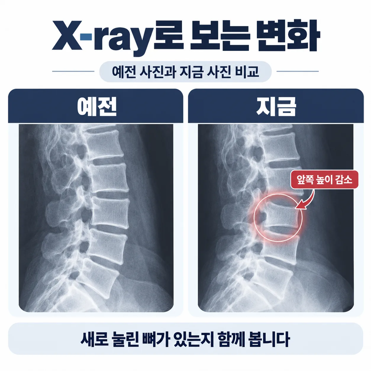 골다공증으로 약해진 척추뼈 앞쪽이 눌려 쐐기 모양이 되는 압박골절 도식